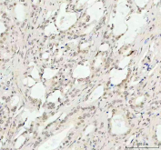 IHC staining of FFPE human prostate cancer tissue with Phospho-AKT1 Antibody. HIER: boil tissue sections in pH8 EDTA for 20 min and allow to cool before testing.