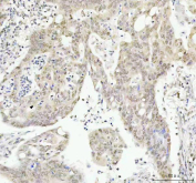 IHC staining of FFPE human colorectal adenocarcinoma tissue with Phospho-AKT1 Antibody. HIER: boil tissue sections in pH8 EDTA for 20 min and allow to cool before testing.