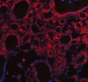 Immunofluorescent staining of FFPE human thyroid cancer tissue with SLC39A10 antibody (red) and DAPI nuclear stain (blue). HIER: steam section in pH8 EDTA buffer for 20 min.