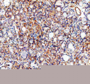 IHC staining of FFPE human thyroid cancer tissue with SLC39A10 antibody, HRP-secondary and DAB substrate. HIER: boil tissue sections in pH8 EDTA for 20 min and allow to cool before testing.