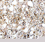 IHC staining of FFPE human breast cancer tissue with SLC39A10 antibody, HRP-secondary and DAB substrate. HIER: boil tissue sections in pH8 EDTA for 20 min and allow to cool before testing.
