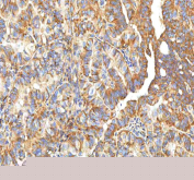 IHC staining of FFPE human thyroid papillary carcinoma tissue with XDH antibody. HIER: boil tissue sections in pH8 EDTA for 20 min and allow to cool before testing.