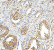 IHC staining of FFPE human prostate cancer tissue with SLC25A25 antibody. HIER: boil tissue sections in pH8 EDTA for 20 min and allow to cool before testing.