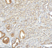 IHC staining of FFPE human prostate cancer tissue with SLC25A25 antibody. HIER: boil tissue sections in pH8 EDTA for 20 min and allow to cool before testing.