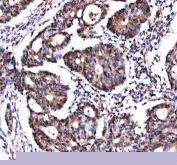 IHC staining of FFPE human colon adenocarcinoma tissue with IPO9 antibody. HIER: boil tissue sections in pH8 EDTA for 20 min and allow to cool before testing.