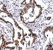 IHC staining of FFPE human pancreas ductal adenocarcinoma tissue with IPO9 antibody. HIER: boil tissue sections in pH8 EDTA for 20 min and allow to cool before testing.