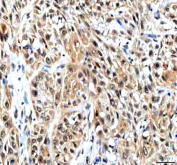 IHC staining of FFPE human urothelial carcinoma tissue with IPO9 antibody. HIER: boil tissue sections in pH8 EDTA for 20 min and allow to cool before testing.