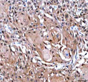 IHC staining of FFPE human urothelial carcinoma tissue with IPO9 antibody. HIER: boil tissue sections in pH8 EDTA for 20 min and allow to cool before testing.