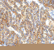 IHC staining of FFPE human thyroid papillary carcinoma tissue with PFKP antibody. HIER: boil tissue sections in pH8 EDTA for 20 min and allow to cool before testing.