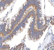 IHC staining of FFPE human colon adenocarcinoma tissue with PFKP antibody. HIER: boil tissue sections in pH8 EDTA for 20 min and allow to cool before testing.