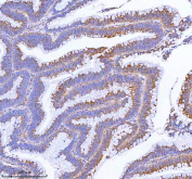 IHC staining of FFPE human colon adenocarcinoma tissue with MLKL antibody. HIER: boil tissue sections in pH8 EDTA for 20 min and allow to cool before testing.