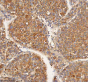 IHC staining of FFPE human liver cancer tissue with HEBP1 antibody. HIER: boil tissue sections in pH8 EDTA for 20 min and allow to cool before testing.