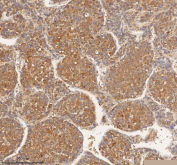 IHC staining of FFPE human liver cancer tissue with HEBP1 antibody. HIER: boil tissue sections in pH8 EDTA for 20 min and allow to cool before testing.