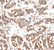 IHC staining of FFPE human breast cancer tissue with INTU antibody. HIER: boil tissue sections in pH8 EDTA for 20 min and allow to cool before testing.