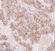 IHC staining of FFPE human thyroid papillary carcinoma tissue with IRS4 antibody. HIER: boil tissue sections in pH8 EDTA for 20 min and allow to cool before testing.