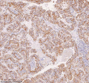 IHC staining of FFPE human thyroid papillary carcinoma tissue with IRS4 antibody. HIER: boil tissue sections in pH8 EDTA for 20 min and allow to cool before testing.