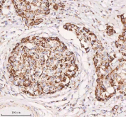 IHC staining of FFPE human human breast cancer tissue with IRS4 antibody. HIER: boil tissue sections in pH8 EDTA for 20 min and allow to cool before testing.