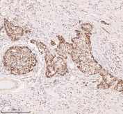 IHC staining of FFPE human human breast cancer tissue with IRS4 antibody. HIER: boil tissue sections in pH8 EDTA for 20 min and allow to cool before testing.