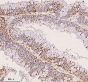 IHC staining of FFPE human human colon adenocarcinoma tissue with IRS4 antibody. HIER: boil tissue sections in pH8 EDTA for 20 min and allow to cool before testing.