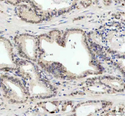 IHC staining of FFPE human prostate cancer tissue with JNK1 antibody. HIER: boil tissue sections in pH8 EDTA for 20 min and allow to cool before testing.