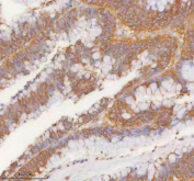 IHC staining of FFPE human colon adenocarcinoma tissue with SLK antibody. HIER: boil tissue sections in pH8 EDTA for 20 min and allow to cool before testing.