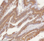 IHC staining of FFPE human colon adenocarcinoma tissue with SLK antibody. HIER: boil tissue sections in pH8 EDTA for 20 min and allow to cool before testing.