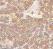 IHC staining of FFPE human thyroid papillary carcinoma tissue with SLK antibody. HIER: boil tissue sections in pH8 EDTA for 20 min and allow to cool before testing.
