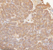 IHC staining of FFPE human thyroid papillary carcinoma tissue with SLK antibody. HIER: boil tissue sections in pH8 EDTA for 20 min and allow to cool before testing.