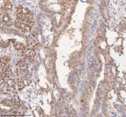 IHC staining of FFPE human ovarian cancer tissue with HSPA1L antibody. HIER: boil tissue sections in pH8 EDTA for 20 min and allow to cool before testing.