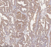 IHC staining of FFPE human ovarian cancer tissue with HSPA1L antibody. HIER: boil tissue sections in pH8 EDTA for 20 min and allow to cool before testing.