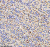 IHC staining of FFPE human glioblastoma tissue with HADHB antibody. HIER: boil tissue sections in pH8 EDTA for 20 min and allow to cool before testing.