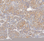 IHC staining of FFPE human liver cancer tissue with HADHB antibody. HIER: boil tissue sections in pH8 EDTA for 20 min and allow to cool before testing.