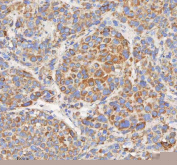 IHC staining of FFPE human liver cancer tissue with HADHB antibody. HIER: boil tissue sections in pH8 EDTA for 20 min and allow to cool before testing.