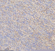 IHC staining of FFPE human glioblastoma tissue with HADHB antibody. HIER: boil tissue sections in pH8 EDTA for 20 min and allow to cool before testing.