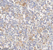 IHC staining of FFPE human testicular seminoma tissue with HADHB antibody. HIER: boil tissue sections in pH8 EDTA for 20 min and allow to cool before testing.