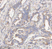 IHC staining of FFPE human pancreas ductal adenocarcinoma tissue with HADHB antibody. HIER: boil tissue sections in pH8 EDTA for 20 min and allow to cool before testing.