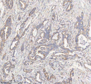 IHC staining of FFPE human pancreas ductal adenocarcinoma tissue with HADHB antibody. HIER: boil tissue sections in pH8 EDTA for 20 min and allow to cool before testing.