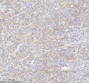 IHC staining of FFPE human urothelial carcinoma tissue with HADHB antibody. HIER: boil tissue sections in pH8 EDTA for 20 min and allow to cool before testing.