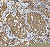 IHC staining of FFPE human lung cancer tissue with SMIM8 antibody. HIER: boil tissue sections in pH8 EDTA for 20 min and allow to cool before testing.