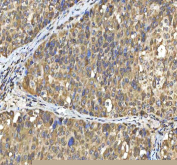 IHC staining of FFPE human liver cancer tissue with SMIM8 antibody. HIER: boil tissue sections in pH8 EDTA for 20 min and allow to cool before testing.