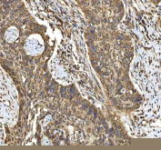 IHC staining of FFPE human laryngeal squamous cell carcinoma tissue with SMIM8 antibody. HIER: boil tissue sections in pH8 EDTA for 20 min and allow to cool before testing.