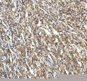 IHC staining of FFPE human diffuse large B cell lymphoma tissue with SMIM8 antibody. HIER: boil tissue sections in pH8 EDTA for 20 min and allow to cool before testing.