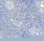 IHC staining of FFPE human spleen tissue with Phospho-HSF1 antibody. HIER: boil tissue sections in pH8 EDTA for 20 min and allow to cool before testing.