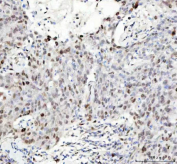 IHC staining of FFPE human breast cancer tissue with Phospho-HSF1 antibody. HIER: boil tissue sections in pH8 EDTA for 20 min and allow to cool before testing.