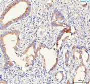 IHC staining of FFPE human colorectal adenocarcinoma tissue with PCDHB14 antibody. HIER: boil tissue sections in pH8 EDTA for 20 min and allow to cool before testing.