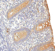 IHC staining of FFPE human appendiceal carcinoid tissue with PCDHB14 antibody. HIER: boil tissue sections in pH8 EDTA for 20 min and allow to cool before testing.