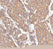IHC staining of FFPE human liver cancer tissue with MANSC4 antibody. HIER: boil tissue sections in pH8 EDTA for 20 min and allow to cool before testing.