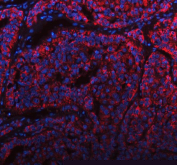 Immunofluorescent staining of FFPE human liver cancer tissue with MANSC4 antibody (red) and DAPI nuclear stain (blue). HIER: steam section in pH8 EDTA buffer for 20 min.