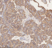 IHC staining of FFPE human thyroid papillary carcinoma tissue with STIM1 antibody. HIER: boil tissue sections in pH8 EDTA for 20 min and allow to cool before testing.