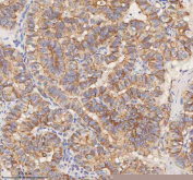 IHC staining of FFPE human thyroid papillary carcinoma tissue with STIM1 antibody. HIER: boil tissue sections in pH8 EDTA for 20 min and allow to cool before testing.